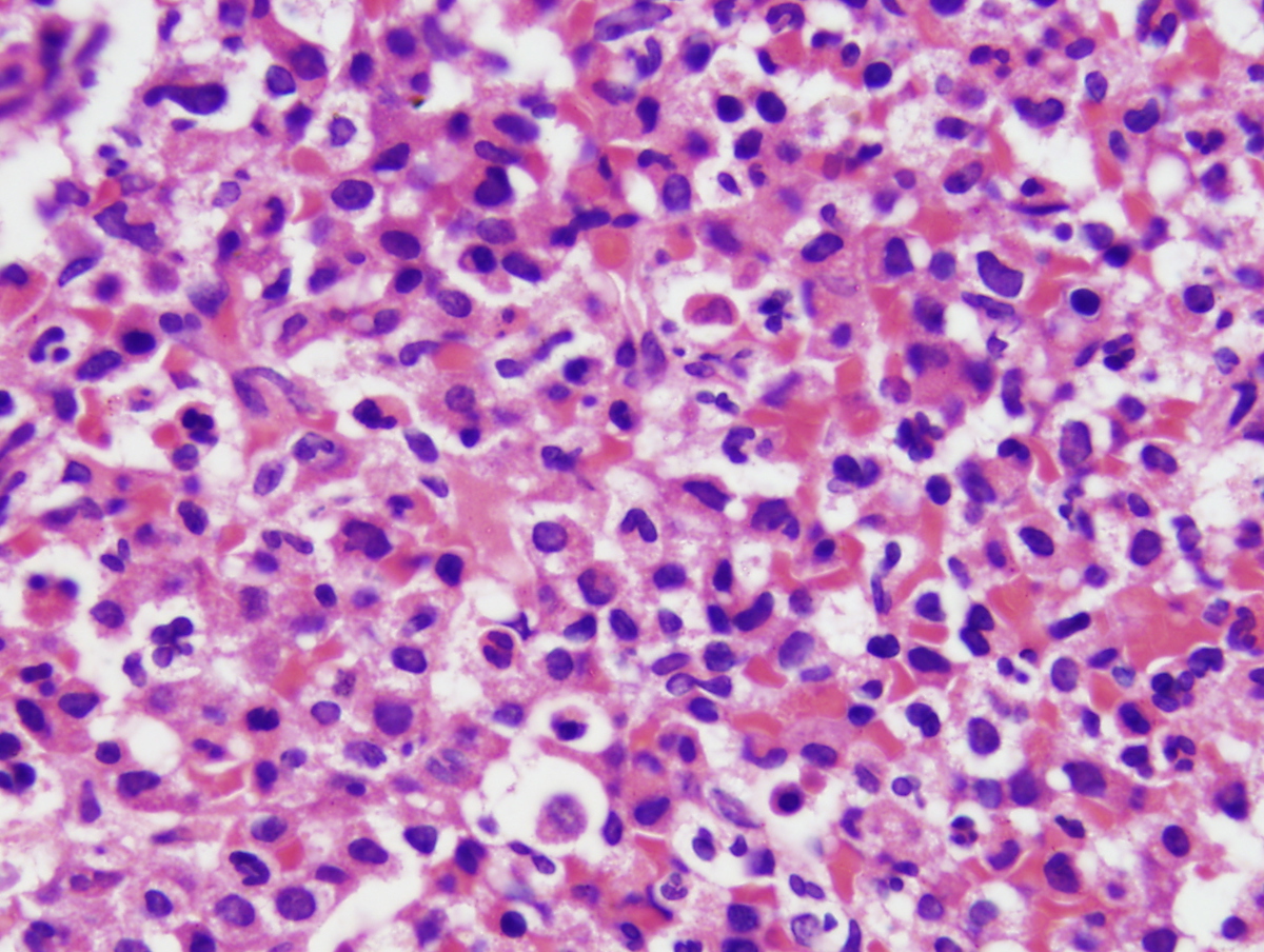 Bone Marrow biopsy